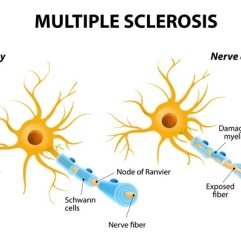 Multiple Sclerosis