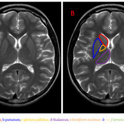 Neurometabolic Disease